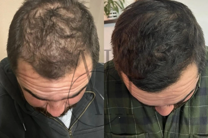 minoxidil side effects
