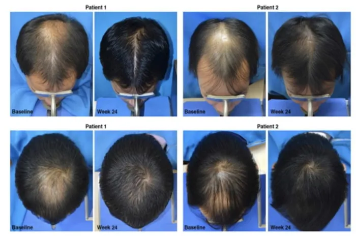 minoxidil_comparison