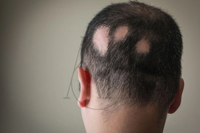 Hair follicle damage causes