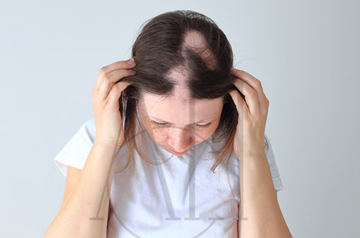 LPP hair loss
