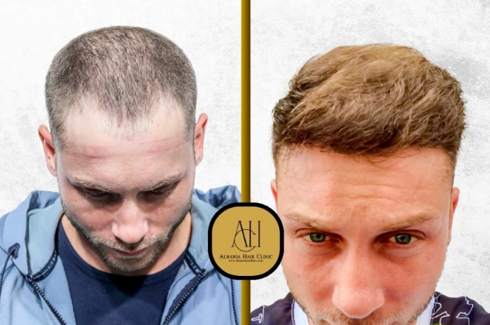 hair transplant natural look