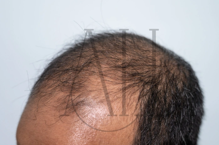genetic hair loss vs telogen effluvium