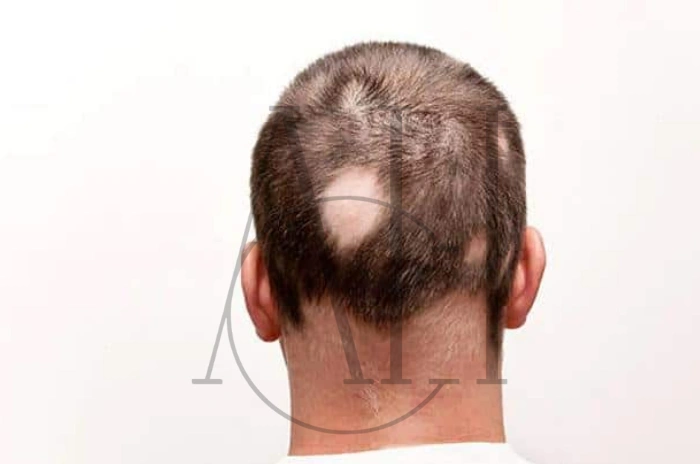 hairstyles that cause traction alopecia