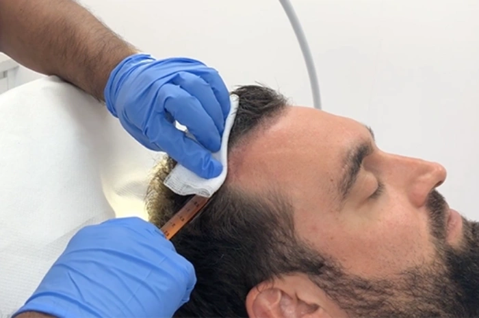 prp therapy side effects