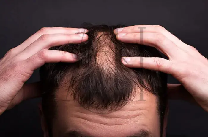 Common Hair Thinning Causes and Symptoms