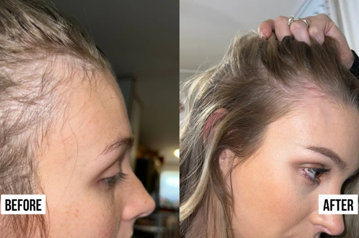 Postpartum hair regrowth