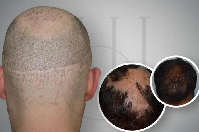 Scarring Alopecia Symptoms