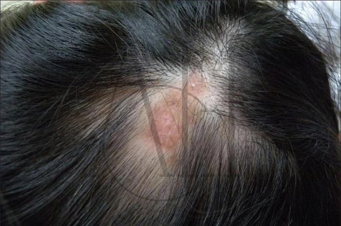 lupus hair loss