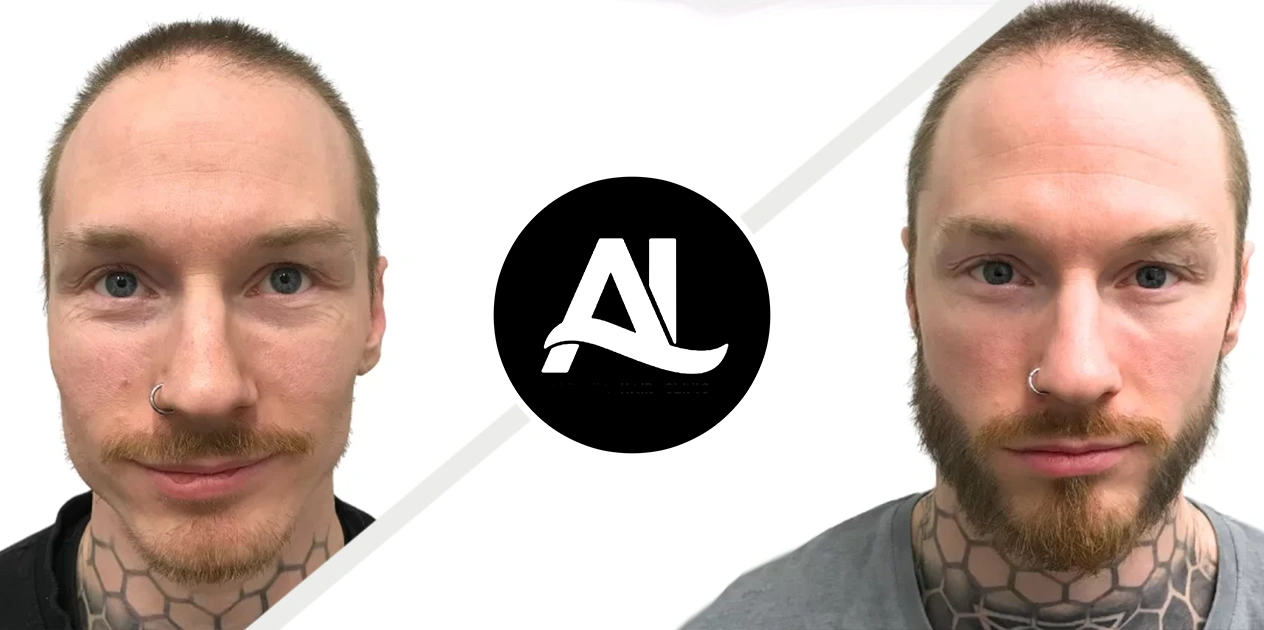 Beard Transplant Before After 1