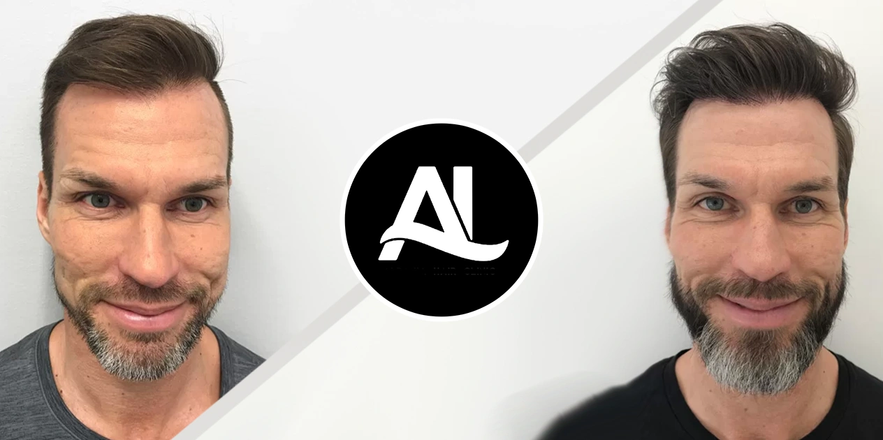 Beard Transplant Before After 2