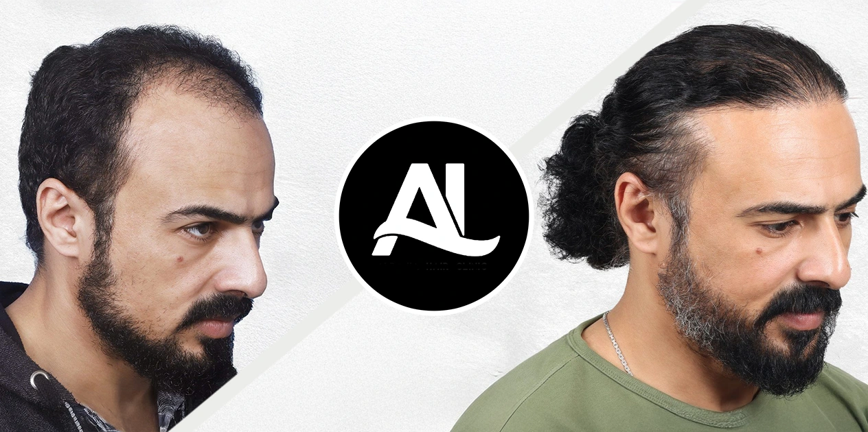 DHI method Before After in tirana 