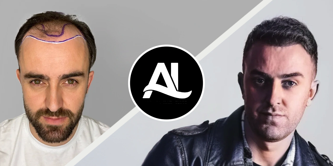 Sapphire FUE Before After in tirana