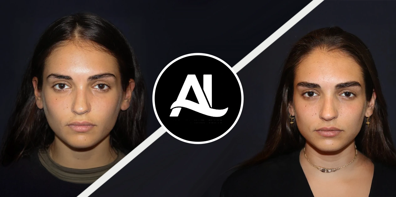 Eyebrow Treatment Before After in Tirana