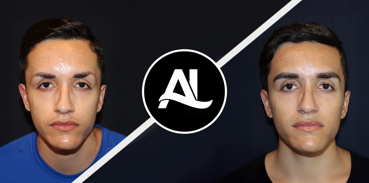 Eyebrow Treatment Before After in albania