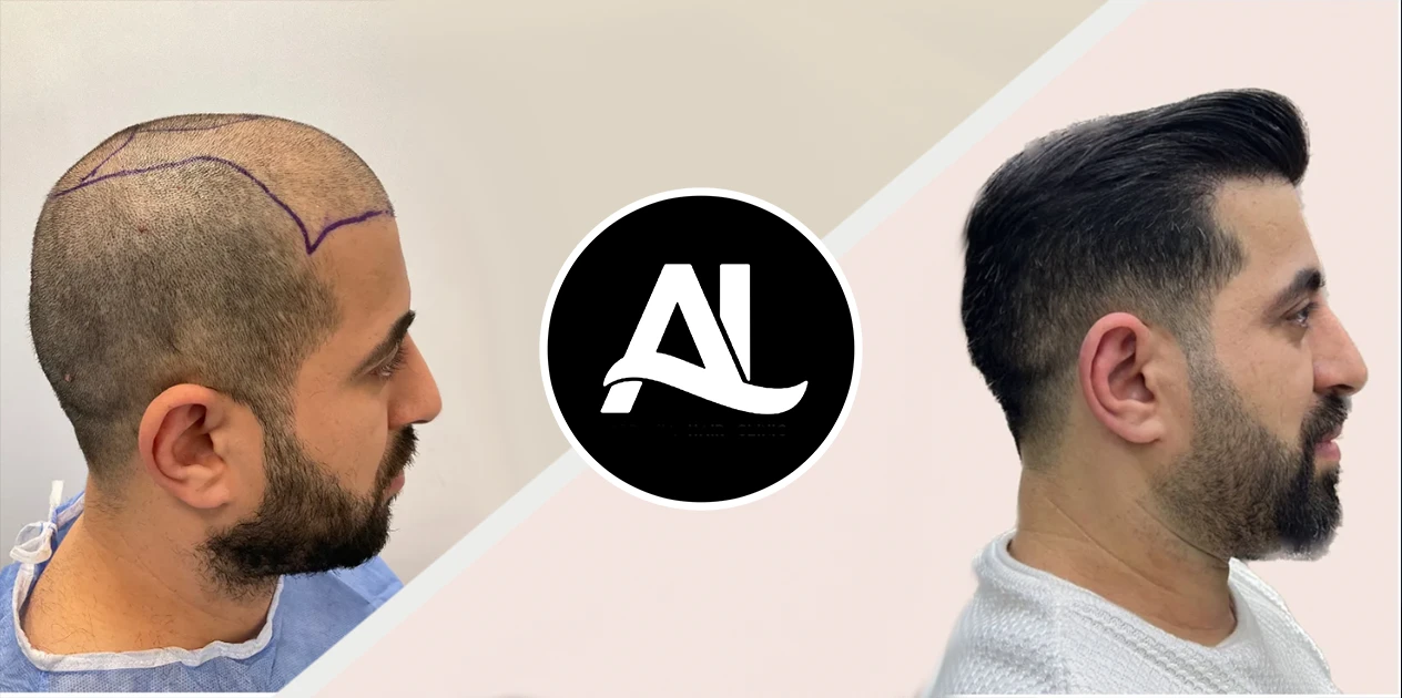 FUE method hair transplant in albania