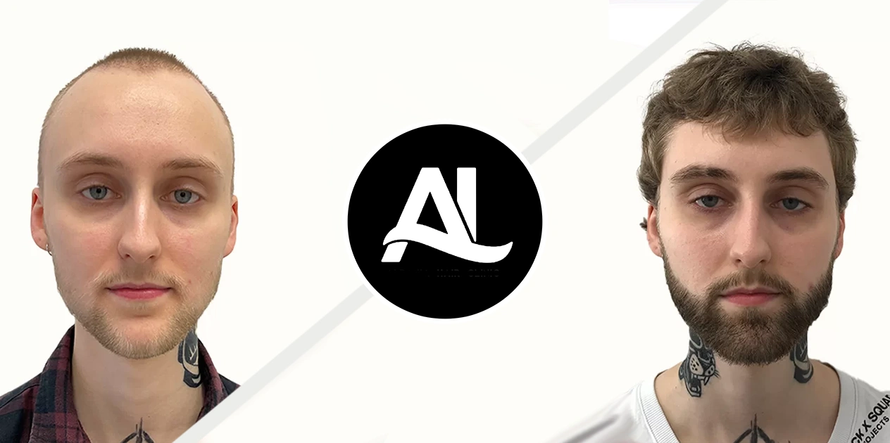 FUE hair transplant in albania