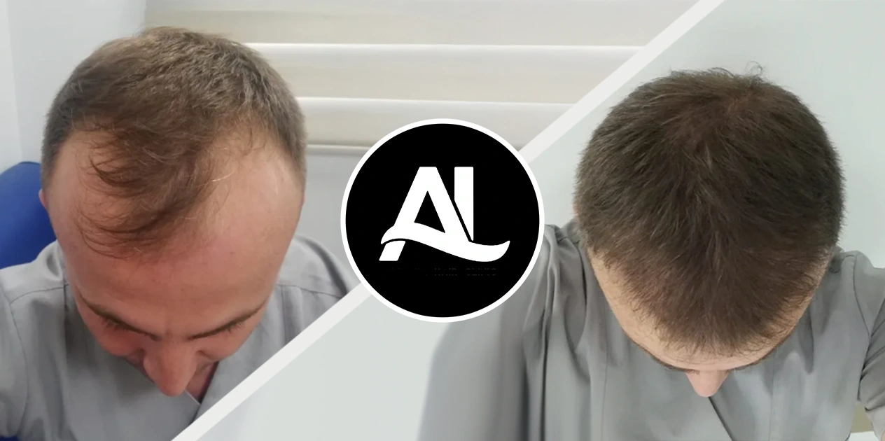 Sapphire FUE Before After Albania