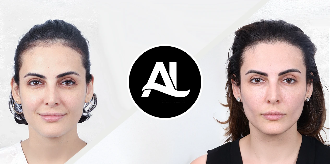 Women Hair Transplant Before After 2