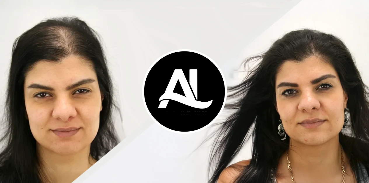 Women Hair Transplant Before After 1